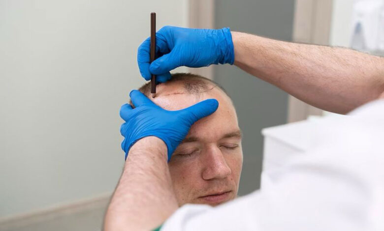 transplantasi-rambut