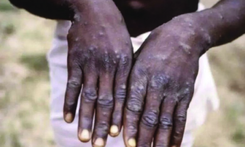 mpox