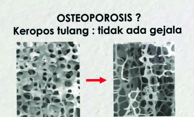 osteoporosis